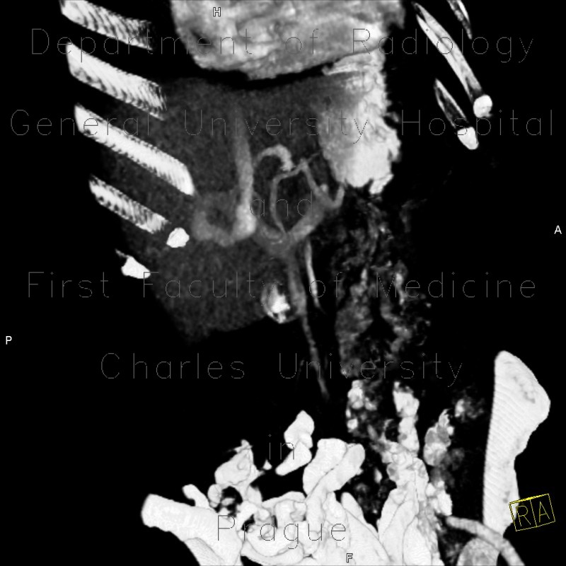 Radiology image - Portocaval shunt in liver, VRT: Abdomen, Liver, Vessels: CT - Computed tomography