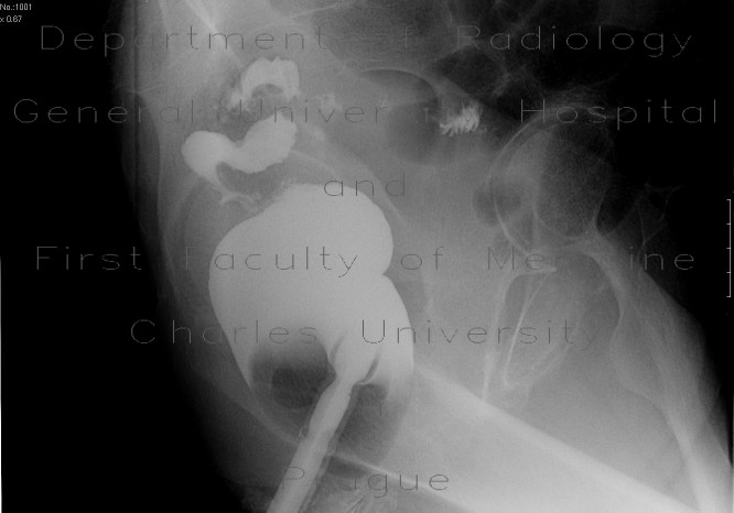 Post-inflammatory stenosis of the sigmoid colon