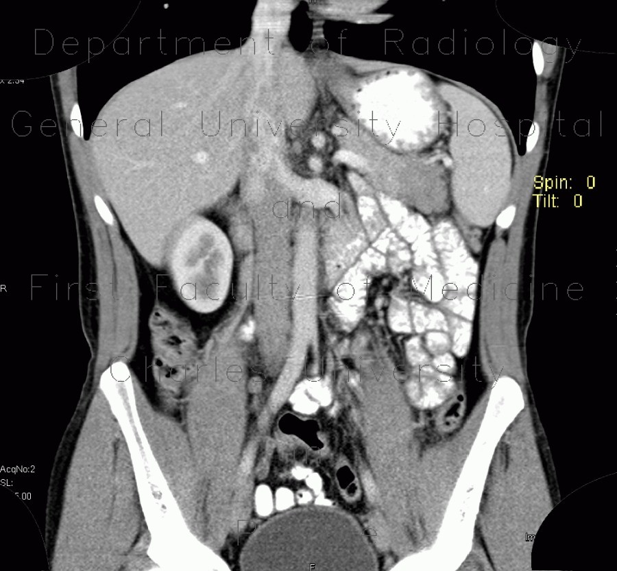 Postinflammatory changes of the tail of pancreas