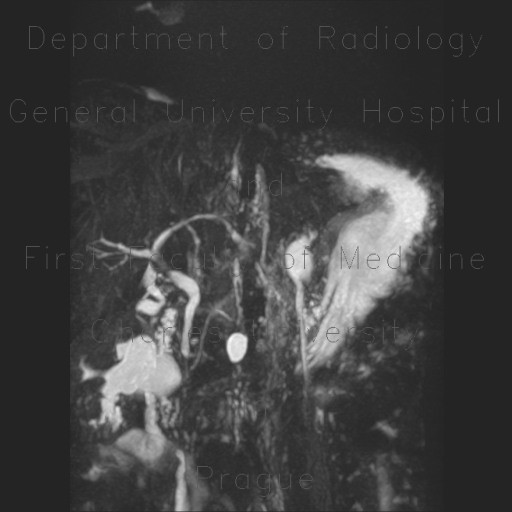 Postinflammatory stenosis of hepatic duct, MRCP, cholecystectomy