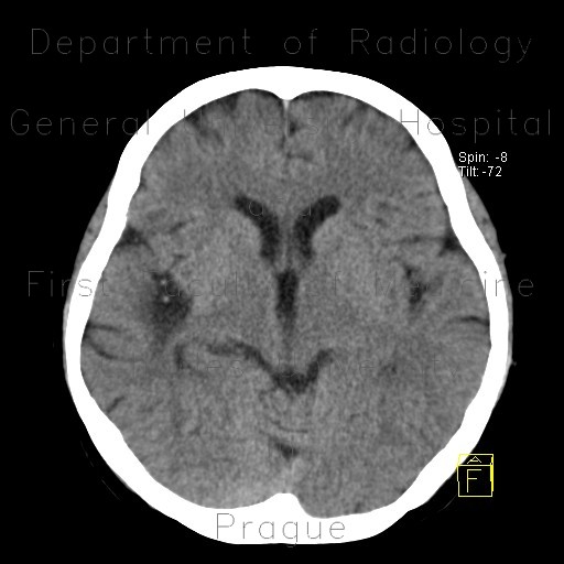 Radiology image - Postischemic gliosis of brain, dense artery: Brain, Brain: CT - Computed tomography