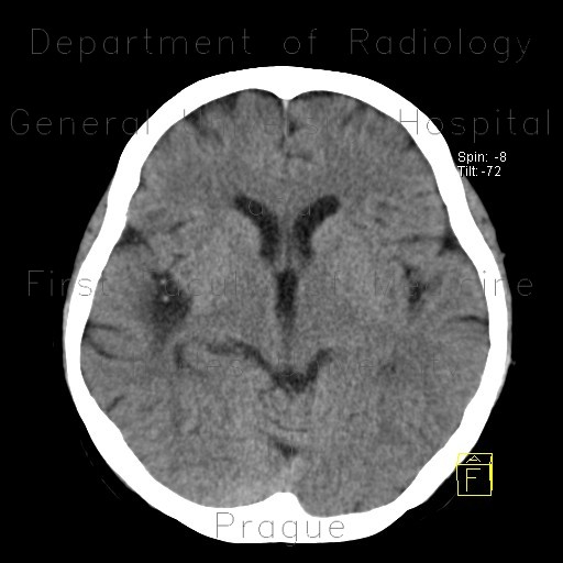 Postischemic gliosis of brain, dense artery