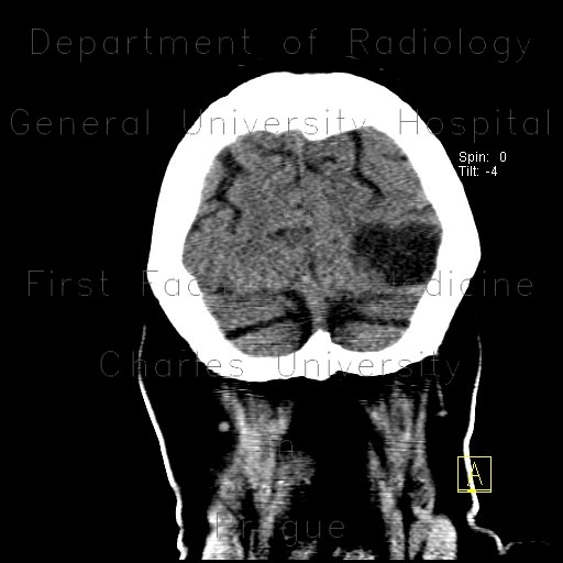 Radiology image - Postmalatic pseudocyst: Brain, Brain: CT - Computed tomography