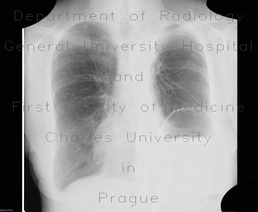 Postoperative pneumoperitoneum