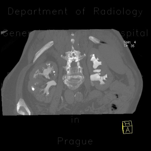 Radiology image - Postpyelonephritic changes, nephrolithiasis, kidney stones: Abdomen, Kidney and adrenals, Urinary tract: CT - Computed tomography