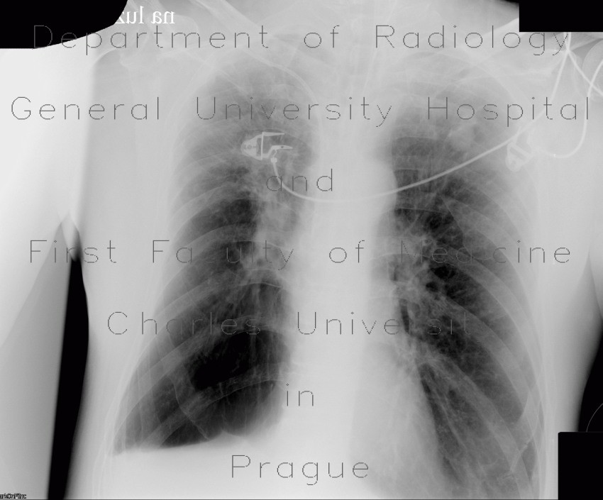 Postspecific changes in lung
