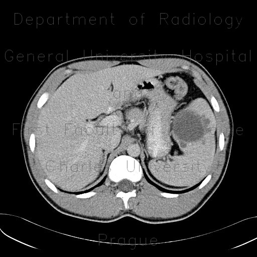 Radiology image - Posttraumatic splenic pseudocyst: Abdomen, Lymphatic: CT - Computed tomography