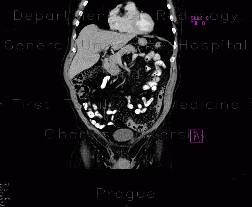 Radiology image - Preperitoneal lipoma: Abdomen, Peritoneal cavity: CT - Computed tomography