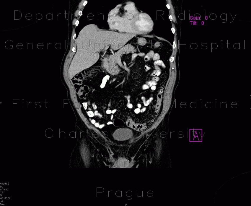 Preperitoneal lipoma