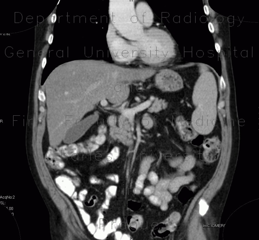 Previous examination with normal liver parenchyma
