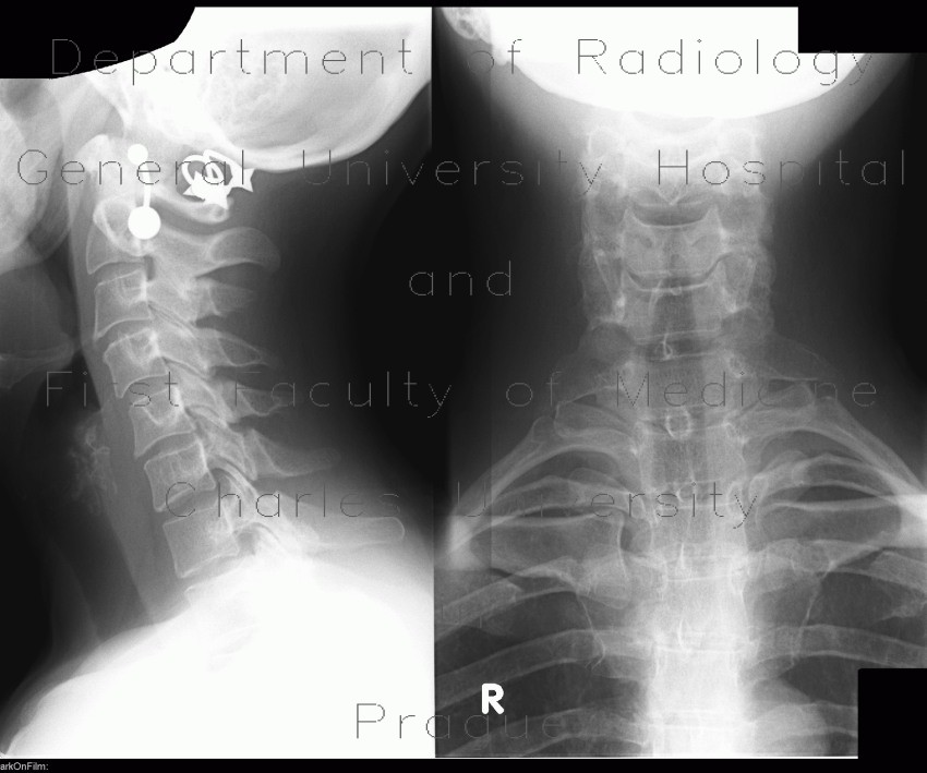 Radiology image - Processus megatransversus: Spine and Axial, Bone: X-ray - Plain radiograph