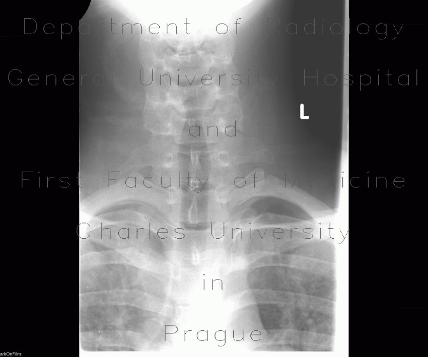 Processus megatransversus, rudimentary rib