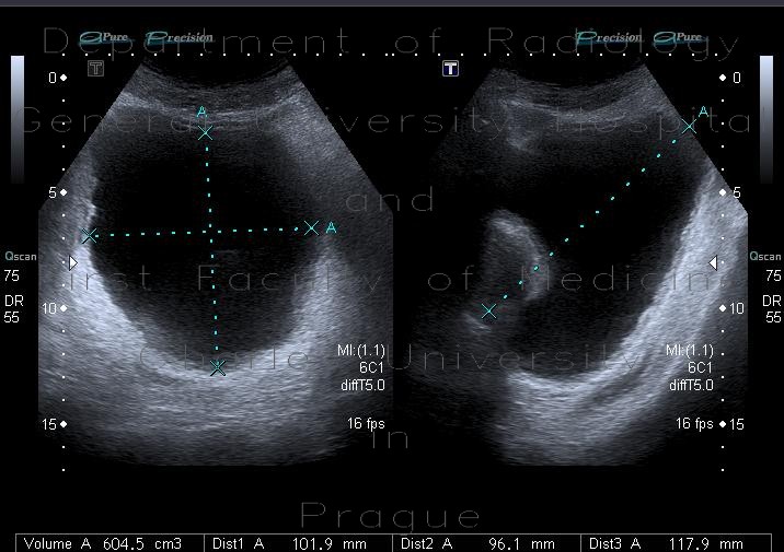 Radiology image - Prostatic hyperplasia, trabecular hypertrophy of urinary bladder: Abdomen, Urinary tract: US - Ultrasound