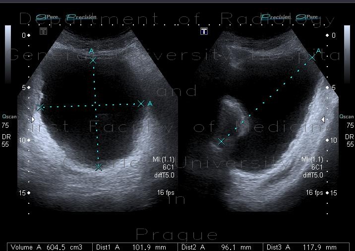 Prostatic hyperplasia, trabecular hypertrophy of urinary bladder