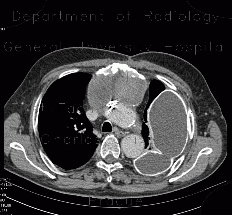 Pseudoaneurysm of aorta, replacement of ascending aorta, haemothorax