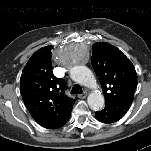 Radiology image - Pseudoaneurysm of ascending aorta: Thorax, Vessels: CT - Computed tomography