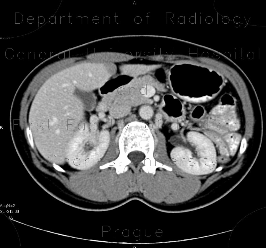 Pseudolesion in liver, falciform ligament
