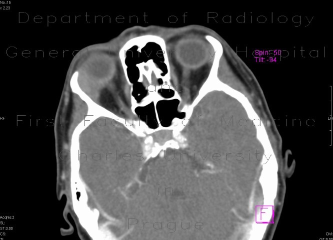 Radiology image - Pseudotumour of lacrimal gland: Head and Neck, Orbit: CT - Computed tomography
