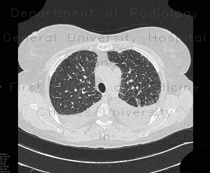 Pulmonary amyloidosis, diffuse parenchymal form