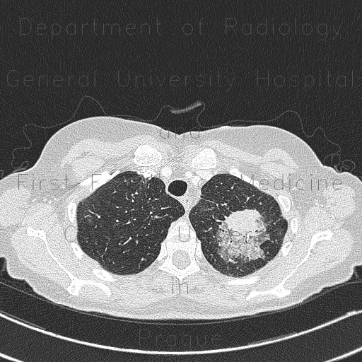 Pulmonary aspergillosis, angioinvasive aspergillosis