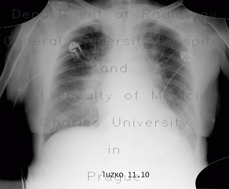 Pulmonary edema, before treatment