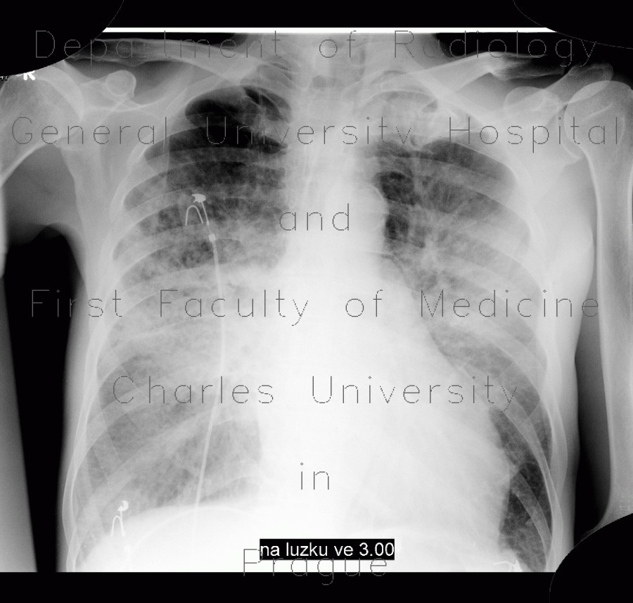 Radiology image - Pulmonary edema, first day: Thorax, Lung: X-ray - Plain radiograph