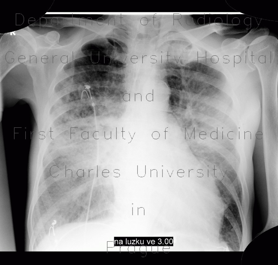 Pulmonary edema, first day