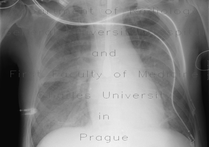 Pulmonary edema, supine chest radiograph