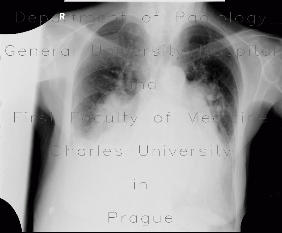 Radiology image - Pulmonary embolism, pulmonary hypertension, cardiomegally, correlation: Thorax, Heart, Vessels: X-ray - Plain radiograph