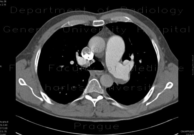 Radiology image - Pulmonary embolism, thrombolysis: Thorax, Vessels: CT - Computed tomography