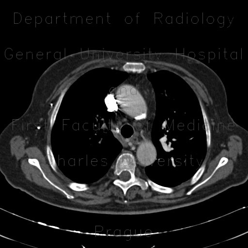 Radiology image - Pulmonary hypertension, obliteration of the right pulmonary artery, hypertrophy of bronchial artery, mosaic perfusion: Thorax, Lung, Mediastinum and pleural cavity, Vessels: CT - Computed tomography