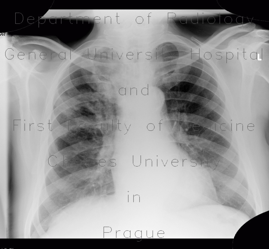 Radiology image - Pulmonary tuberculosis, TBC, tuberculosis: Thorax, Lung, Mediastinum and pleural cavity: X-ray - Plain radiograph