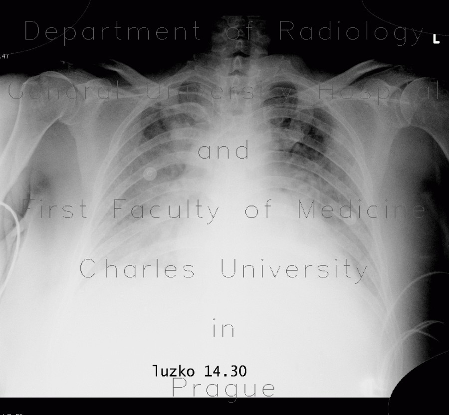 Pumonary edema, pneumonia