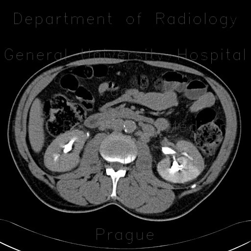 Pyelocystitis, narrowing of calyceal neck