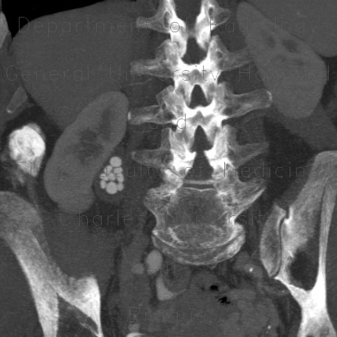 Pyelolithiasis, nephrolithiasis, kidney stones in renal pelvis