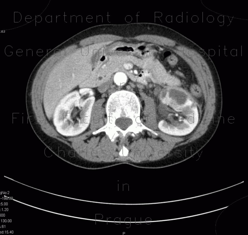 pyelonephritis x ray