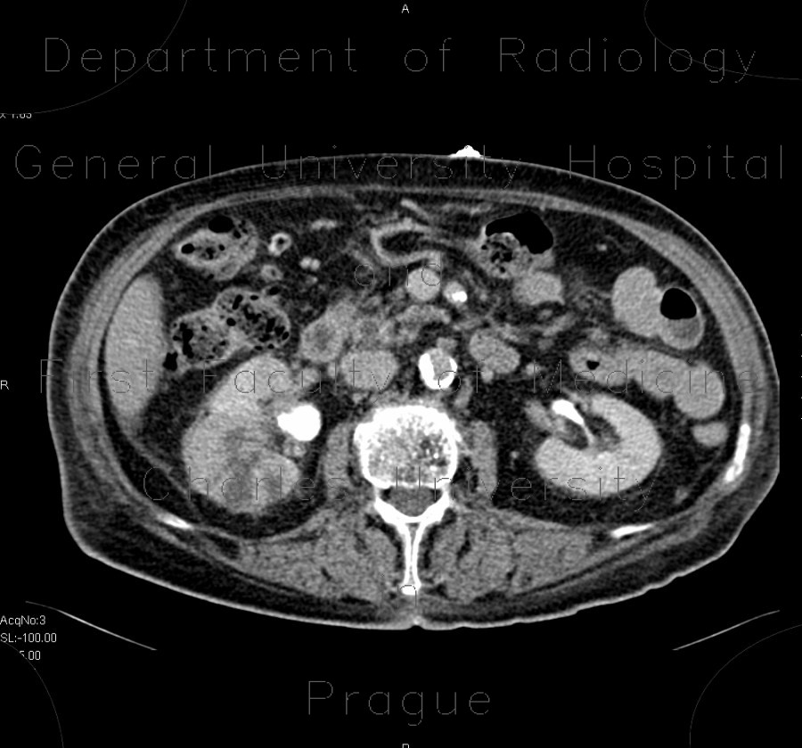 Pyelonephritis, kidney