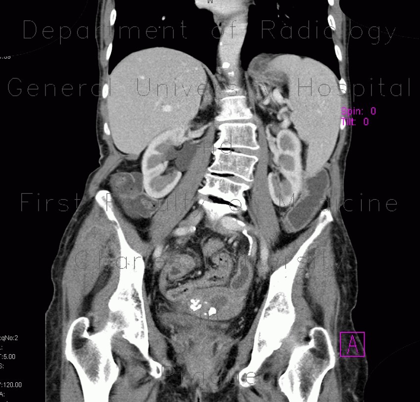 Pyometra, reactive changes of small bowel