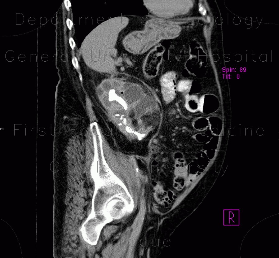 Radiology image - Pyonephros, renal stones, casting, staghorn calculus, nephrolithiasis: Abdomen, Kidney and adrenals: CT - Computed tomography
