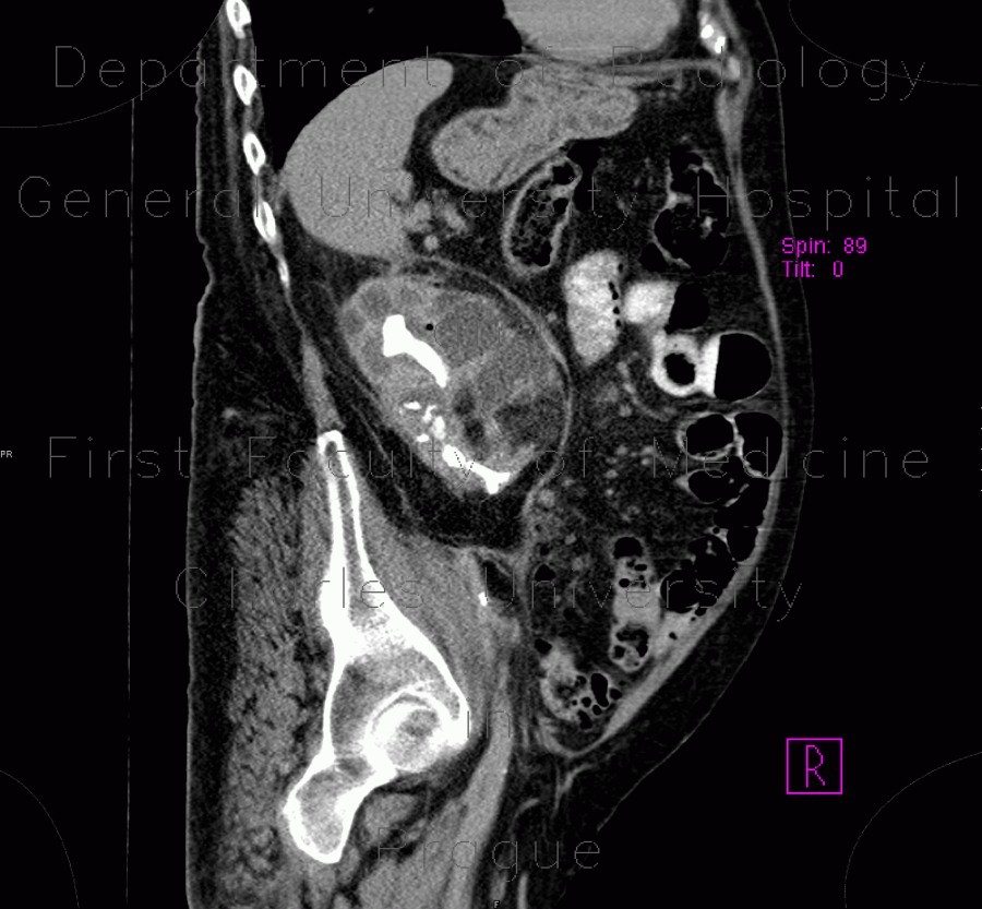 Pyonephros, renal stones, casting, staghorn calculus, nephrolithiasis