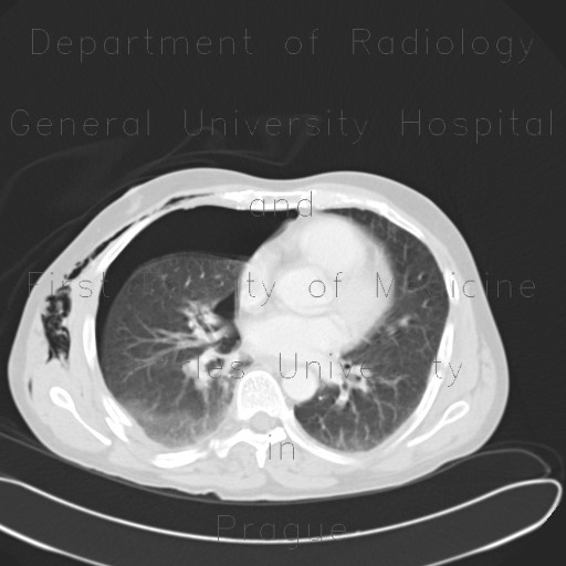 Radiology image - RTA, pneumothorax, subcutaneous emphysema, soft tissue damage, fracture of iliac crest, rib fracture: Abdomen, Thorax, Bone, Liver, Mediastinum and pleural cavity, Soft tissue: CT - Computed tomography