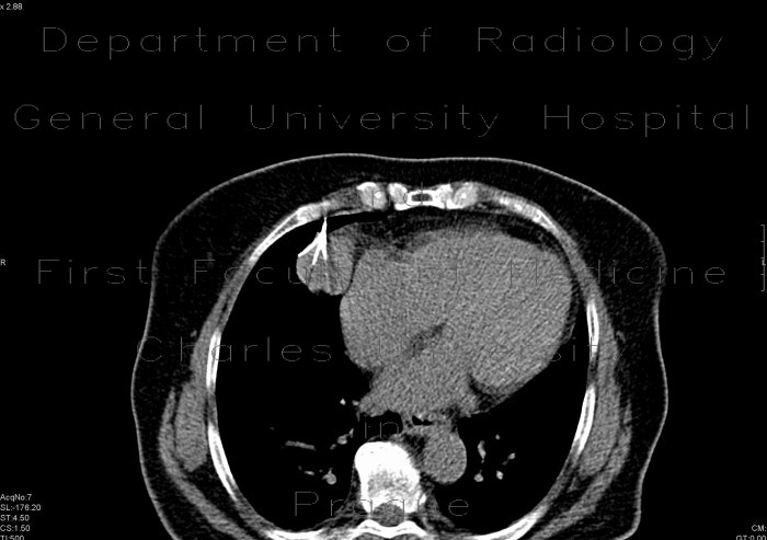 Radiology image - Radiofrequency ablation, RFA, mediastinal tumour: Thorax, Mediastinum and pleural cavity: CT - Computed tomography