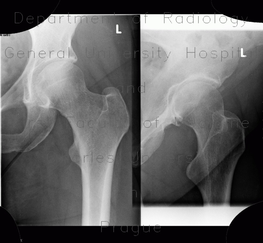 Radiology image - Reactive arthritis, arthritis in salmonellosis, salmonella: Extremity, Bone, Soft tissue: X-ray - Plain radiograph
