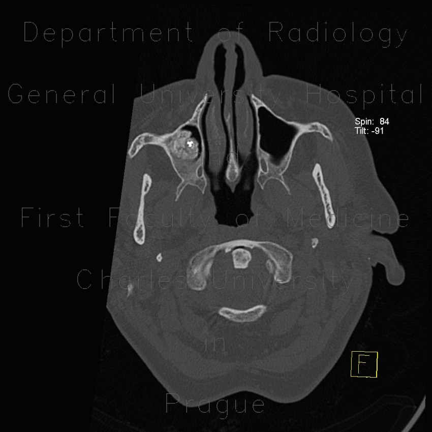 Reactive bone around tooth implant