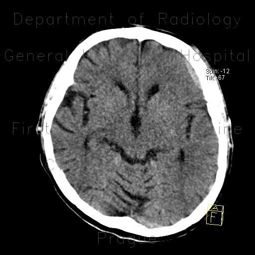 Radiology image - Rebleeding into chronic subdural hematoma: Brain, Brain: CT - Computed tomography