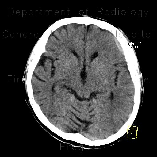 Rebleeding into chronic subdural hematoma