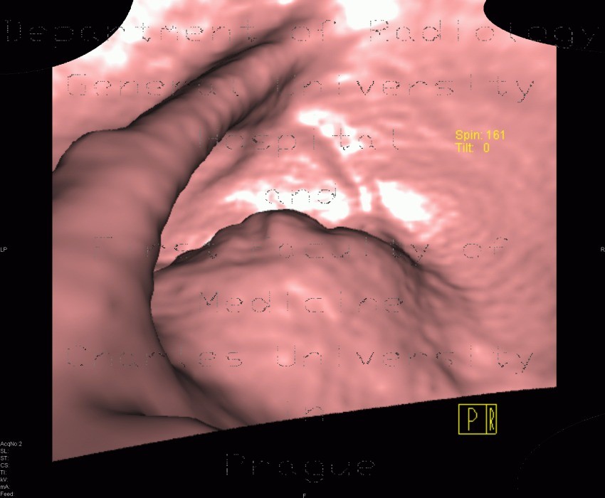 Rectal tumour, virtual colonography