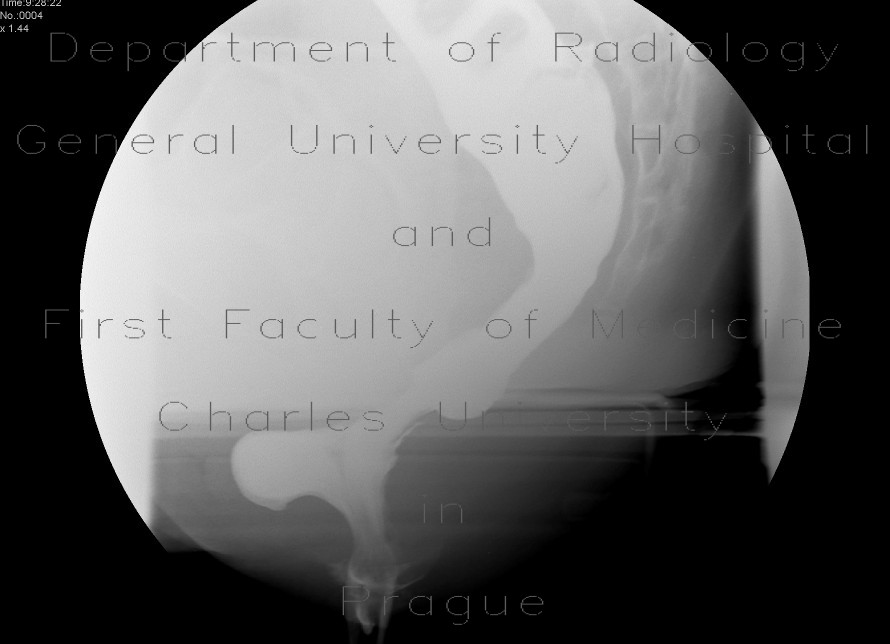 Radiology image - Rectocoele with ulcer, intussusception: Abdomen, Large bowel: RF - Fluoroscopy