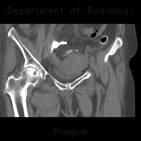 Radiology image - Rectovaginal fistula: Abdomen, Gynecology, Large bowel: CT - Computed tomography