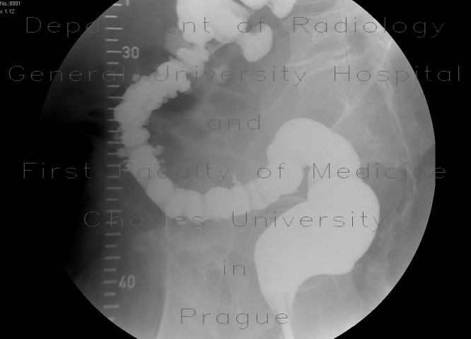 Rectovaginal fistula, diverticular disease of the sigmoid colon